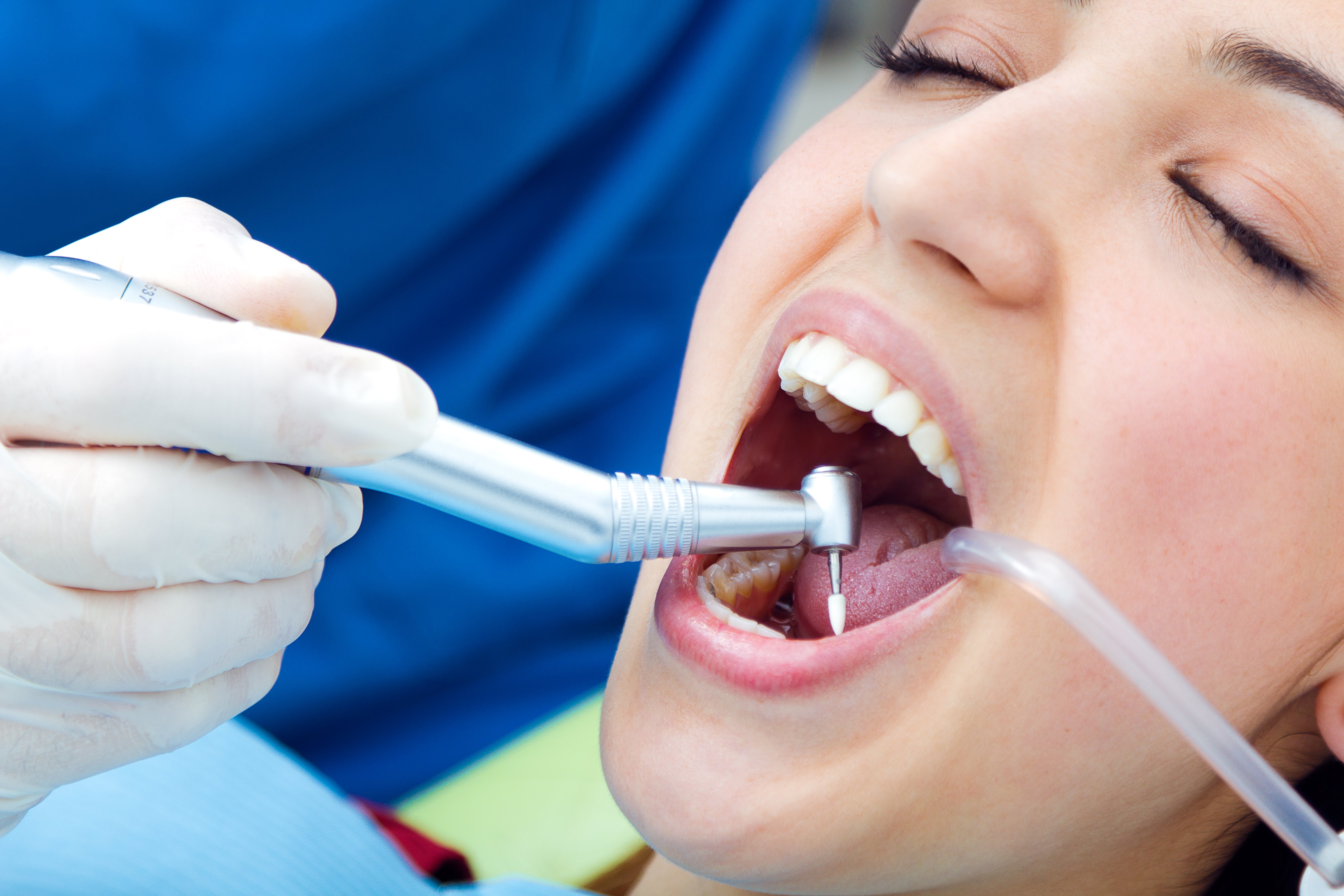 Tooth coloured dental filling treatment in Leicester