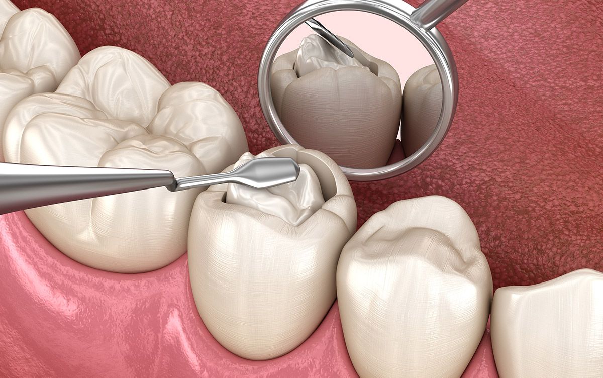 Dental fillings in Leicester at Dentist 111