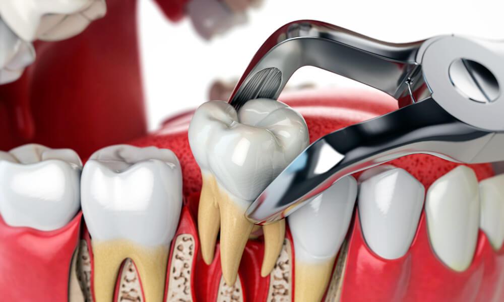 Safe tooth extraction in Leicester at Dentist 111